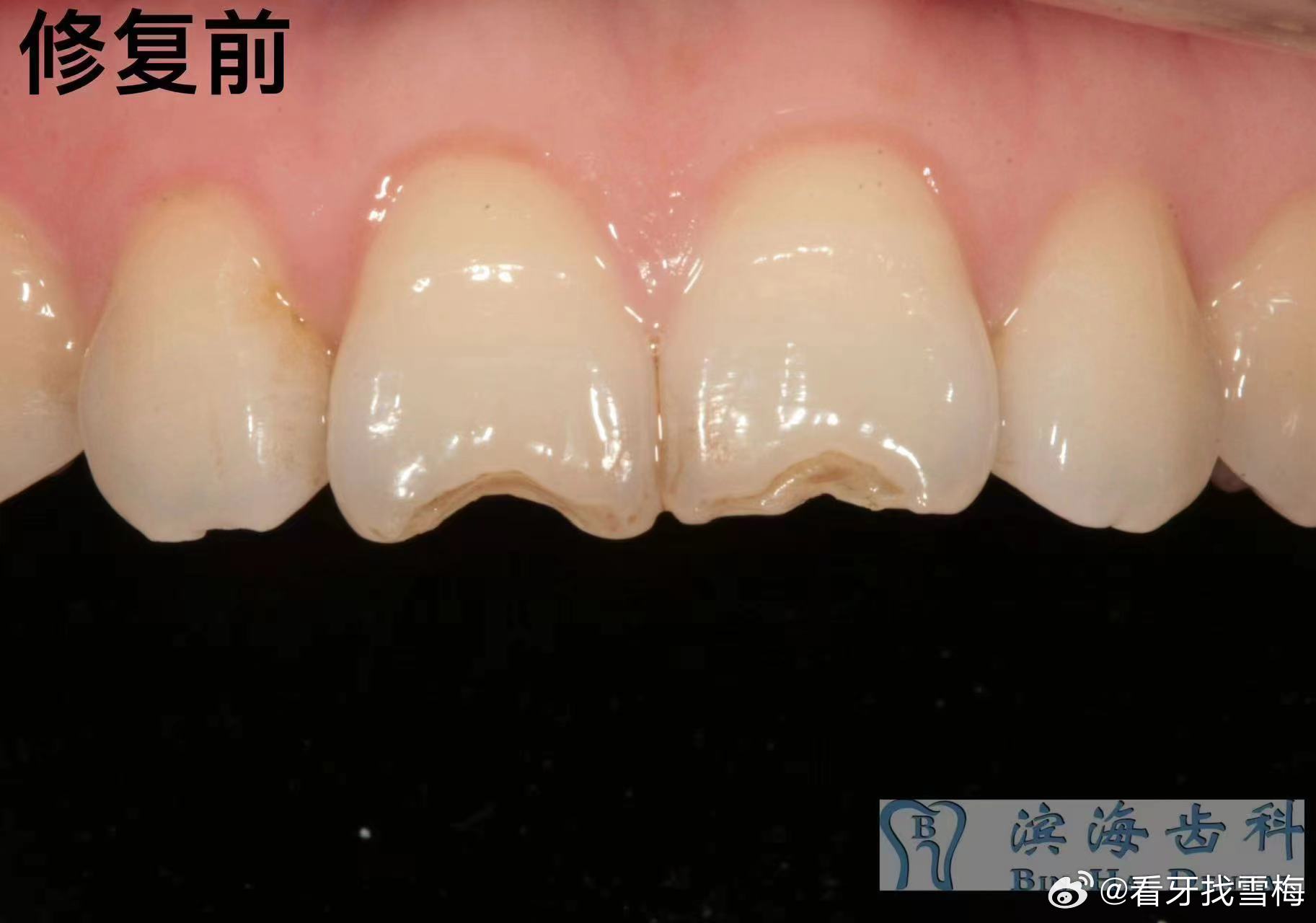 最新牙齿修复技术，重塑一口新牙的神奇之旅